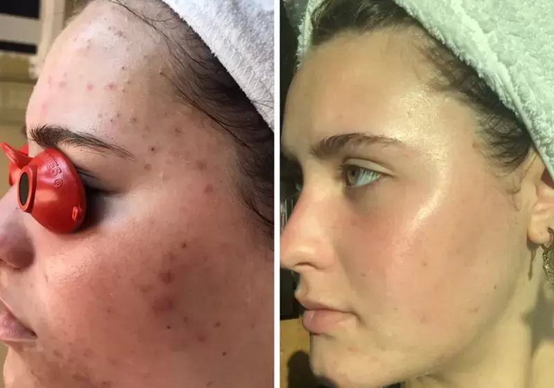 Acne Face Skincare Treatment by Certified Specialist