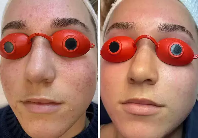 Before and After Acne Treatment at Dana Point Acne Lab