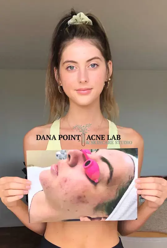 Face Acne Reality Treatment in Dana Point Lab